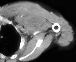 Breast Cancer With Nodes and Subcutaneous Nodules - CTisus CT Scan