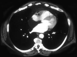 Intrapericardial Lipoma - CTisus CT Scan