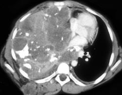 Osteogenic Sarcoma Involves the Hemithorax - CTisus CT Scan