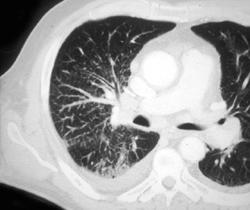 Lymphangetic Spread Due to Cancer - CTisus CT Scan