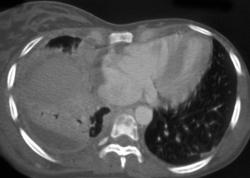 Pleural Implants Due to Metastatic Breast Cancer - CTisus CT Scan