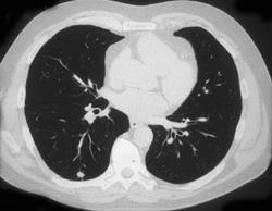 Extramedullary Hematopoesis - CTisus CT Scan