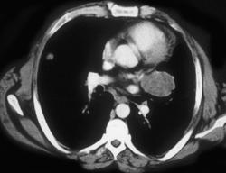 Testicular Cancer - CTisus CT Scan