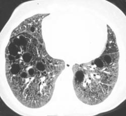 Lymphangioleiomyomatosis (LAM) - CTisus CT Scan