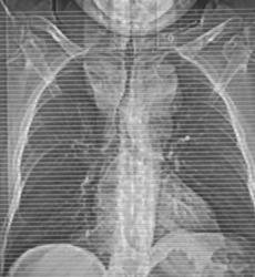 Substernal Thyroid - CTisus CT Scan