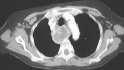 Posteriorly Located Ectopic Parathyroid Adenoma - CTisus CT Scan