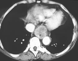 Esophageal Cancer With Celiac Nodes - CTisus CT Scan