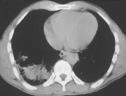 Pneumothorax and Pulmonary Contusion - CTisus CT Scan