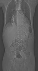 Dense Liver Due to Amiodarone Toxicity - CTisus CT Scan