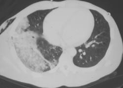 Pulmonary Contusion and Liver Laceration - CTisus CT Scan