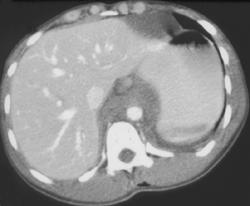 Posterior Mediastinal Hematoma Due to Trauma - CTisus CT Scan