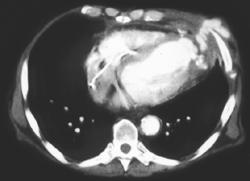 Bleed From Left Ventricle - CTisus CT Scan