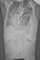 Ruptured Diaphragm - CTisus CT Scan