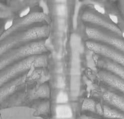 Focal Dissection - CTisus CT Scan