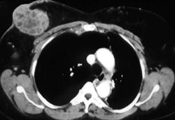 Left Breast Cancer With Internal Mammary and Axillary Nodes - CTisus CT Scan