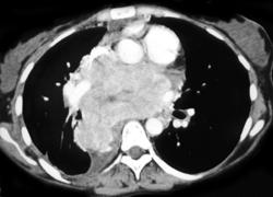 Neurogenic Tumor Invades the Heart - CTisus CT Scan