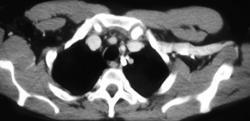 Thoracic Duct With Contrast - CTisus CT Scan