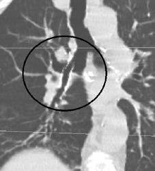 Endostent Displaced and Blocks Right Mainstem Bronchus - CTisus CT Scan