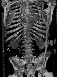 Axillary-fem Bypass Graft - CTisus CT Scan