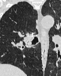 Foreign Body in Airway - CTisus CT Scan