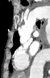 Aortic Aneurysm - CTisus CT Scan