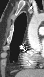 Motion in Ascending Aorta on 4 Slice CT System - CTisus CT Scan