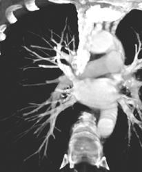 Normal Pulmonary Arteries - CTisus CT Scan