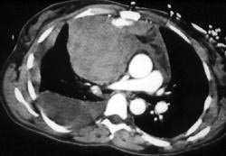 Bleed From Internal Mammary Artery With Mediastinal Hematoma - CTisus CT Scan