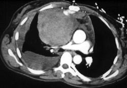 Mediastinal Bleed - CTisus CT Scan