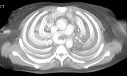 Pulmonary Sling - CTisus CT Scan