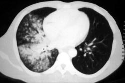 Aspirated Coke Spoon and Aspirated Pneumonia - CTisus CT Scan