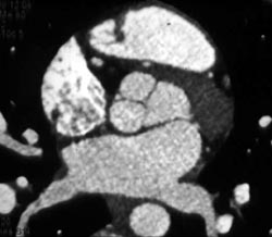 Normal Aortic Root - CTisus CT Scan