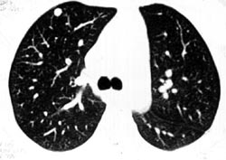 Calcified Nodule - CTisus CT Scan