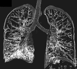 Bronchiectasis of Right Lower Lung - CTisus CT Scan