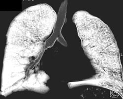 3D of Dilated Bronchi - CTisus CT Scan