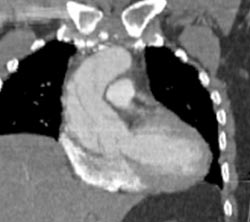 Type A Dissection - CTisus CT Scan