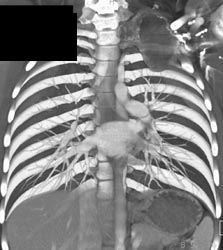 Aneurysmal Bone Cyst in Ribs - CTisus CT Scan