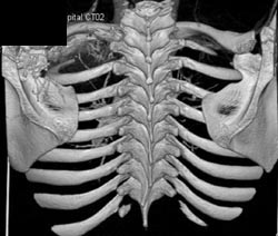 Aneurysmal Bone Cyst - CTisus CT Scan