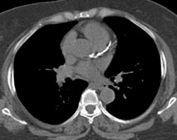 LAD Calcification - CTisus CT Scan