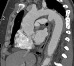 Ductus Aneurysm - CTisus CT Scan