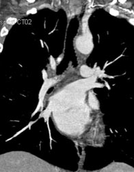 Normal Pulmonary Vasculature - CTisus CT Scan