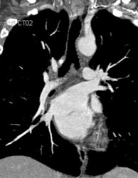 Normal Vasculature - CTisus CT Scan