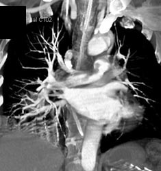 Pulmonary Embolism - CTisus CT Scan