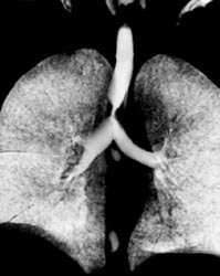 Tracheal Stenosis - CTisus CT Scan