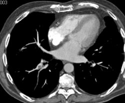 Pulmonary Embolism - CTisus CT Scan