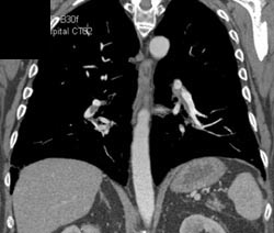 Pulmonary Embolism - CTisus CT Scan