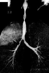 Tracheal Stenosis - CTisus CT Scan