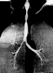 Tracheal Stenosis - CTisus CT Scan