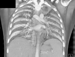 Pulmonary Embolism - CTisus CT Scan