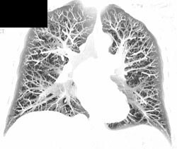 Normal Lungs - CTisus CT Scan